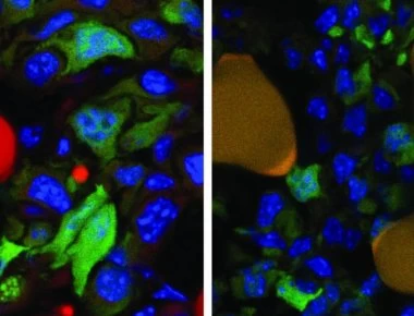 Ιατρική επανάσταση: Μετέτρεψαν καρκινικά κύτταρα σε λίπος